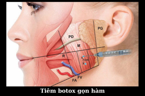 tiem-botox-bao-lau-tan-3