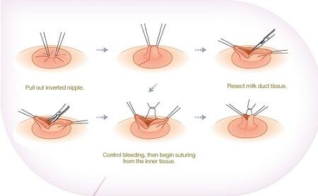 keo-num-vu-tut-gia-bao-nhieu-1