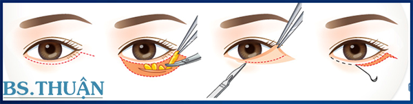 Kỹ thuật cắt mí mắt dưới qua da
