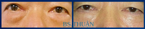 trước và sau phẫu thuật thẩm mỹ lấy da mỡ thừa mi mắt dưới