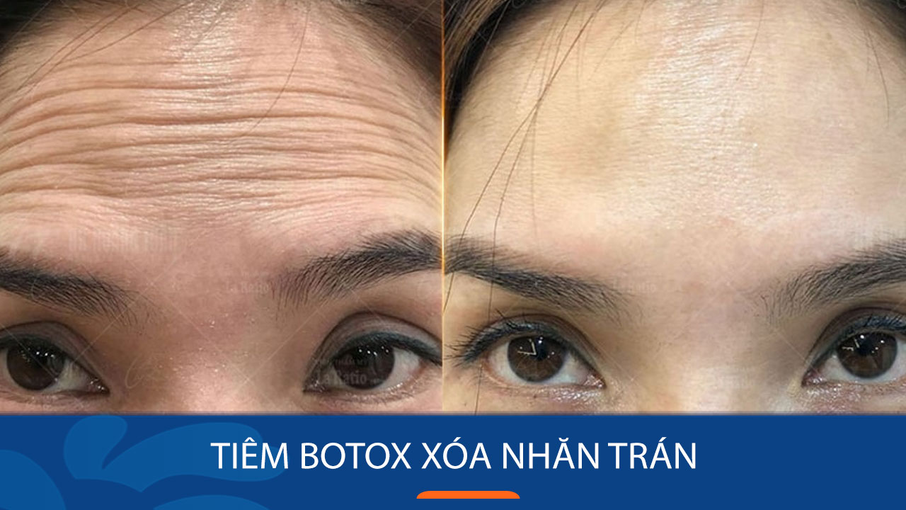 tiem-botox-xoa-nep-nhan-tran-nhu-the-nao-2