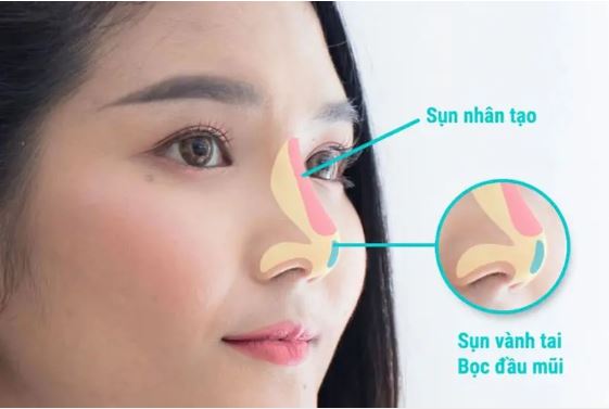 nang-mui-boc-sun-co-nguy-hiem-khong-2