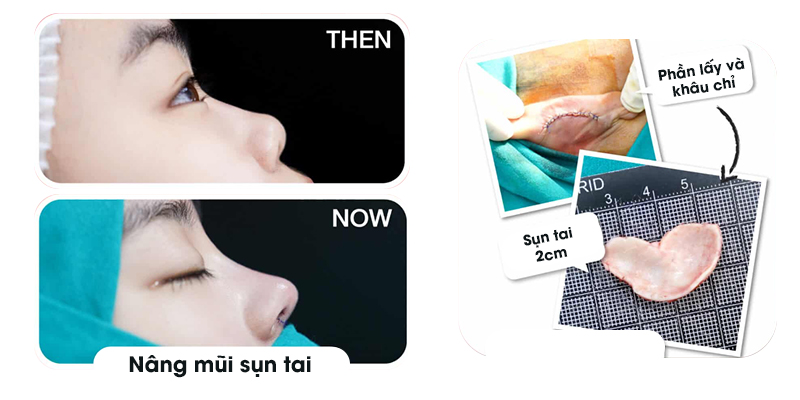 nang-mui-boc-sun-co-nguy-hiem-khong-3