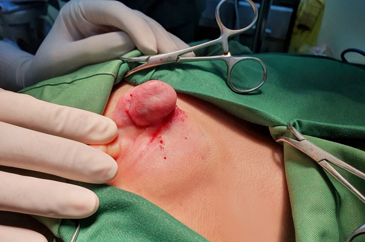 khi-nao-can-phau-thuat-seo-loi-dai-tai-3