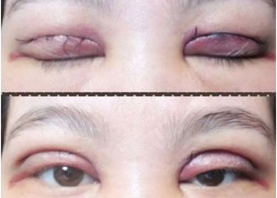 cat-mi-mat-hong-nguyen-nhan-va-cach-khac-phuc-1