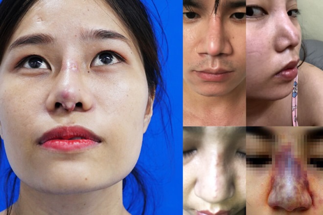 nang-mui-bi-hong-co-sua-lai-duoc-khong-1