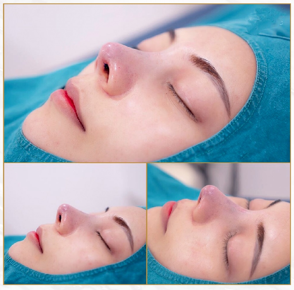 nang-mui-bi-hong-co-sua-lai-duoc-khong-3