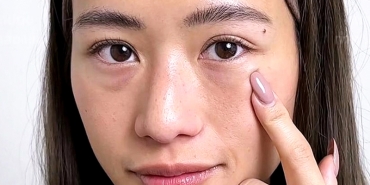 Bọng mắt dưới ở người trẻ có nên phẫu thuật không?