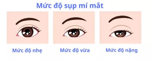 sup-mi-mat-co-tu-khoi-khong-va-cach-dieu-tri-2