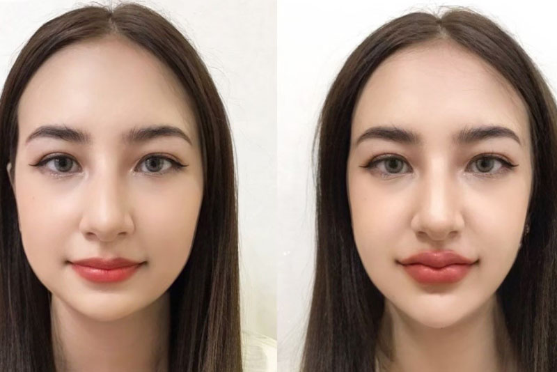 tiem-filler-cam-bao-lau-thi-vao-form-on-dinh-1