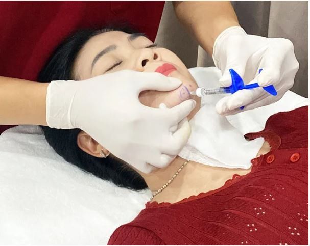 tiem-filler-cam-bao-lau-thi-vao-form-on-dinh-2
