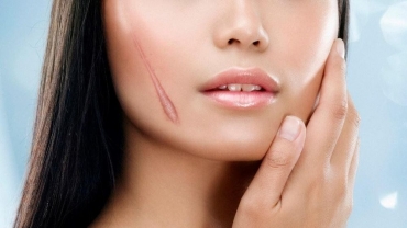Trị sẹo lồi cần kiêng những gì