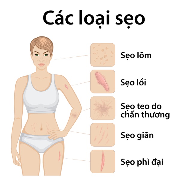 cac-loai-seo-thuong-gap-3
