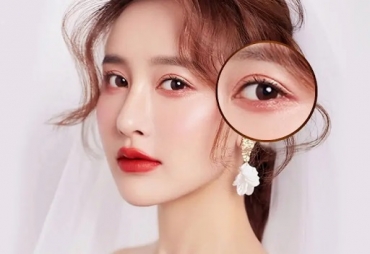 Mở rộng góc mắt trong có nguy hiểm không? Quy trình và lưu ý quan trọng