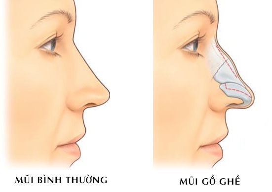 mui-go-la-gi-cach-khac-phuc-mui-go-1