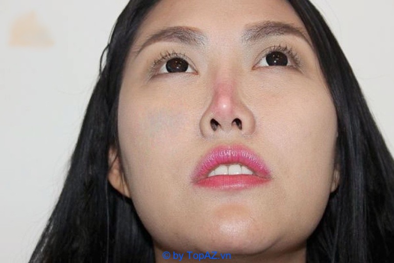 nang-mui-boc-sun-van-bi-do-dau-mui-la-do-dau-1