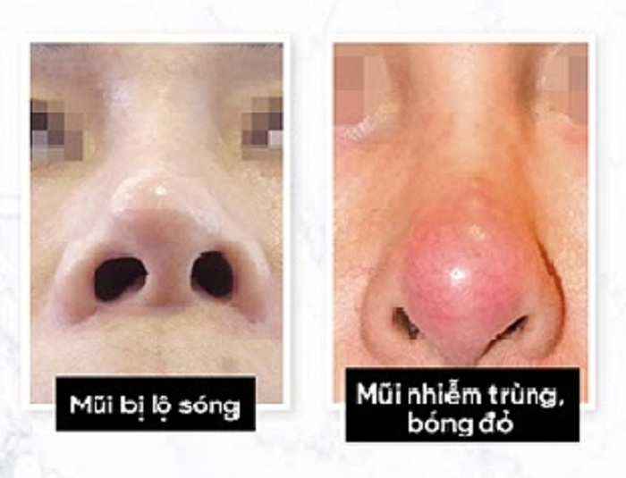 nang-mui-boc-sun-van-bi-do-dau-mui-la-do-dau-2