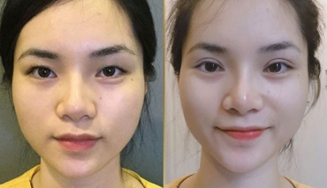 Thẩm mỹ cắt mí mắt an toàn, không đau đẹp chuẩn Hàn Quốc