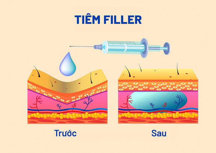 don-cam-bang-filler-can-luu-y-dieu-gi-3