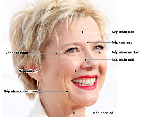 xoa-nep-nhan-bang-botox-co-hai-khong-1