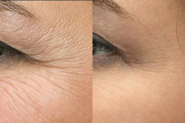 xoa-nep-nhan-bang-botox-co-hai-khong-3
