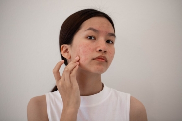 Trị sẹo rỗ ở đâu tốt nhất tại TpHCM