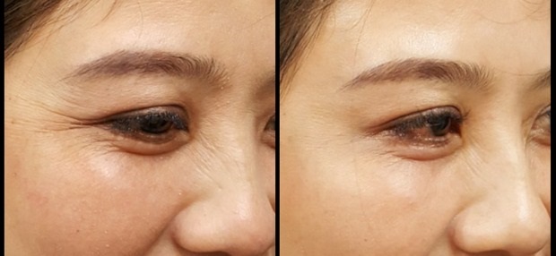 nhung-luu-y-khi-tiem-botox-xoa-nhan-mat-1