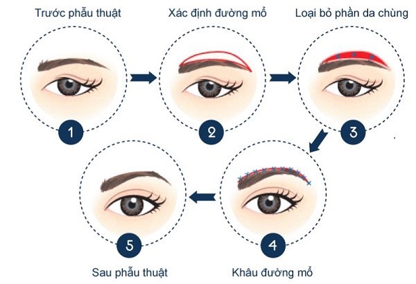 nhung-luu-y-khi-thuc-hien-nang-cao-chan-may-1
