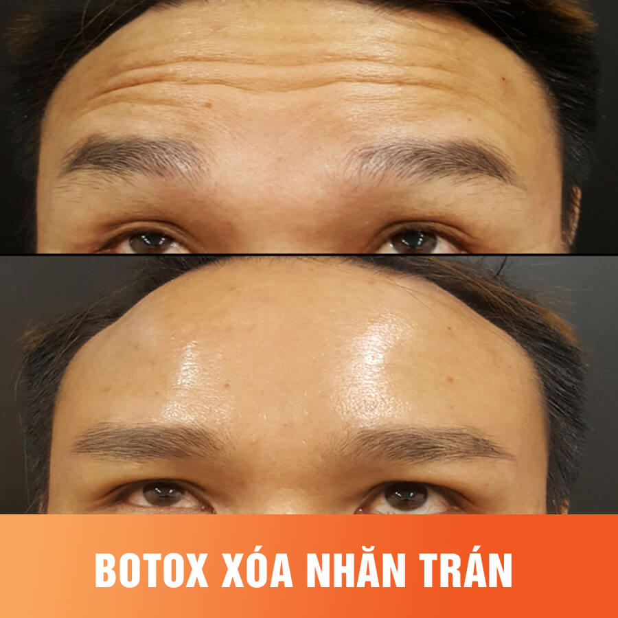 tiem-botox-xoa-nep-nhan-co-tot-khong-3