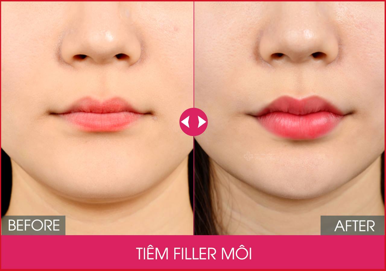 tiem-filler-moi-co-anh-huong-gi-khong-3