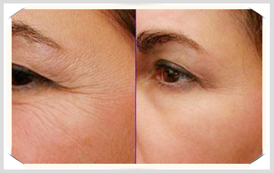 xoa-nep-nhan-mat-bang-botox-co-thuc-su-hieu-qua-1