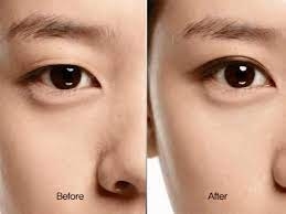 Cắt mí mắt có để lại sẹo không? Quy trình, ưu điểm và cách chăm sóc chuẩn y khoa