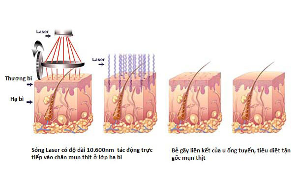 tri-seo-loi-bang-laser-co-hieu-qua-khong-3