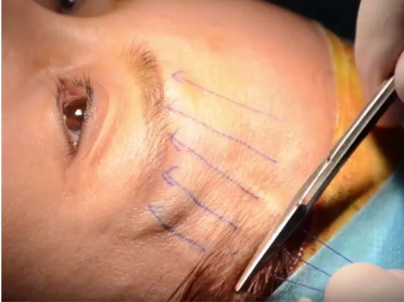 treo-mi-mat-bang-chi-co-hieu-qua-khong-2