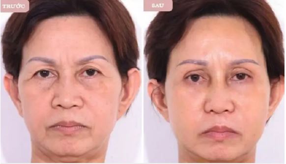 treo-mi-mat-bang-chi-co-hieu-qua-khong-3